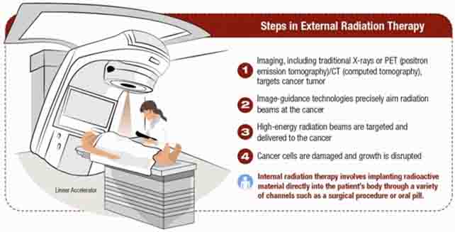 Radiation Therapy